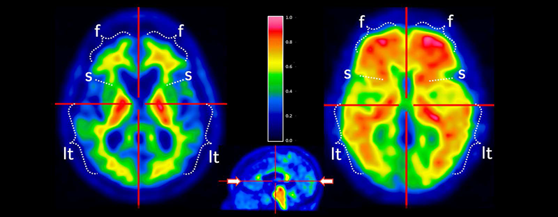 neuroplasticity brain scans